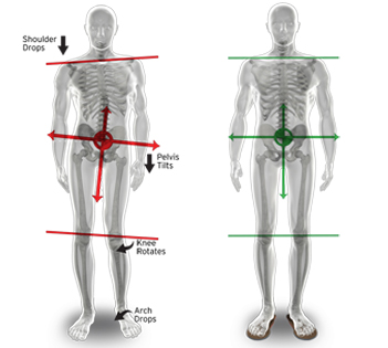 Alinhamento com uso de palmilha e fisioterapia